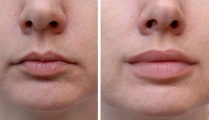 What Are Dermal Fillers and How Do They Work?